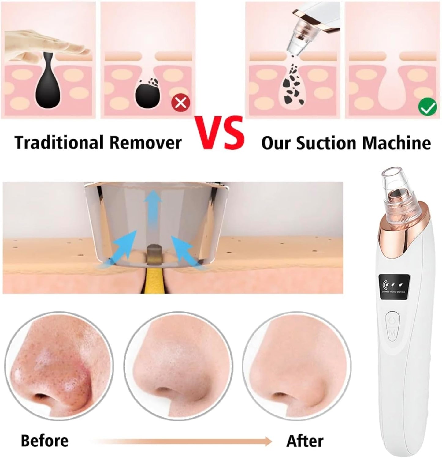 Faker Blackhead Remover
